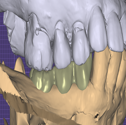 Dental Case Studies at Dental Lab in Atlanta, GA